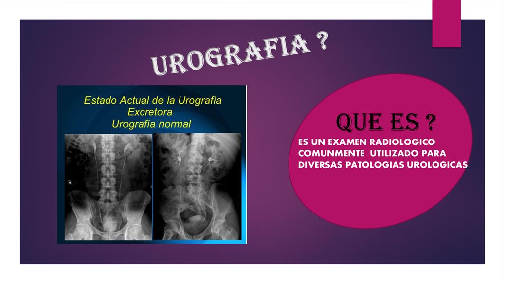 Dieta ligera para urografias